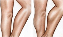 Lipofilling-calves-Tunisia